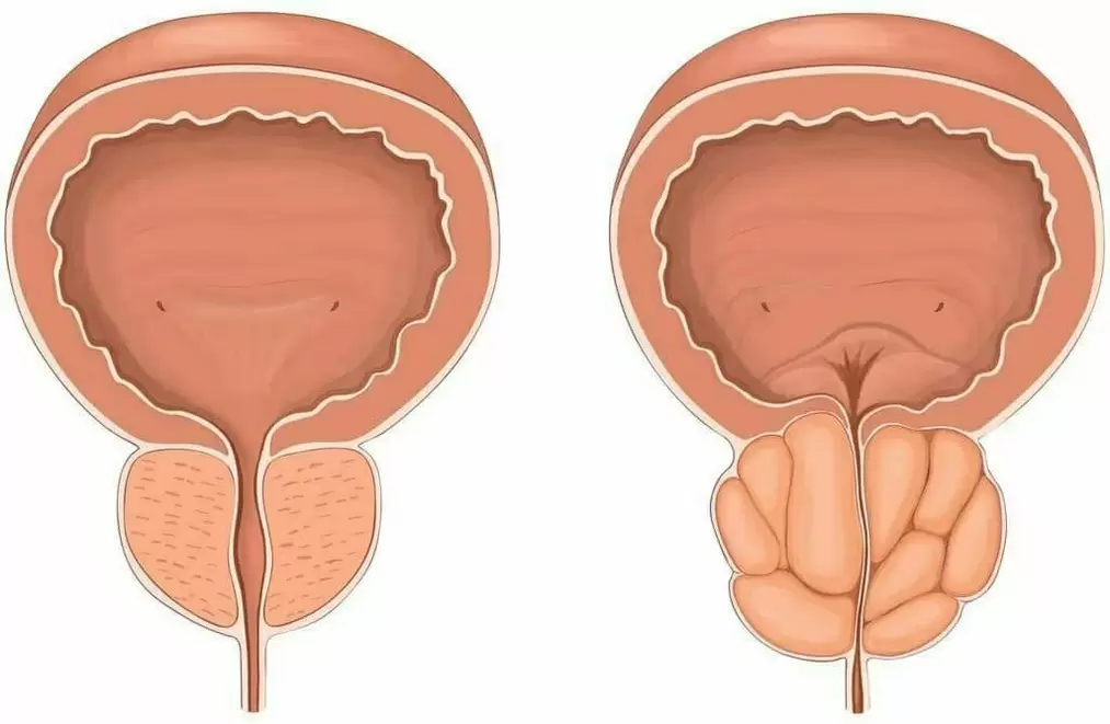 Próstata e prostatite saudables